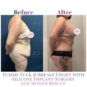 before-after photo body-lift