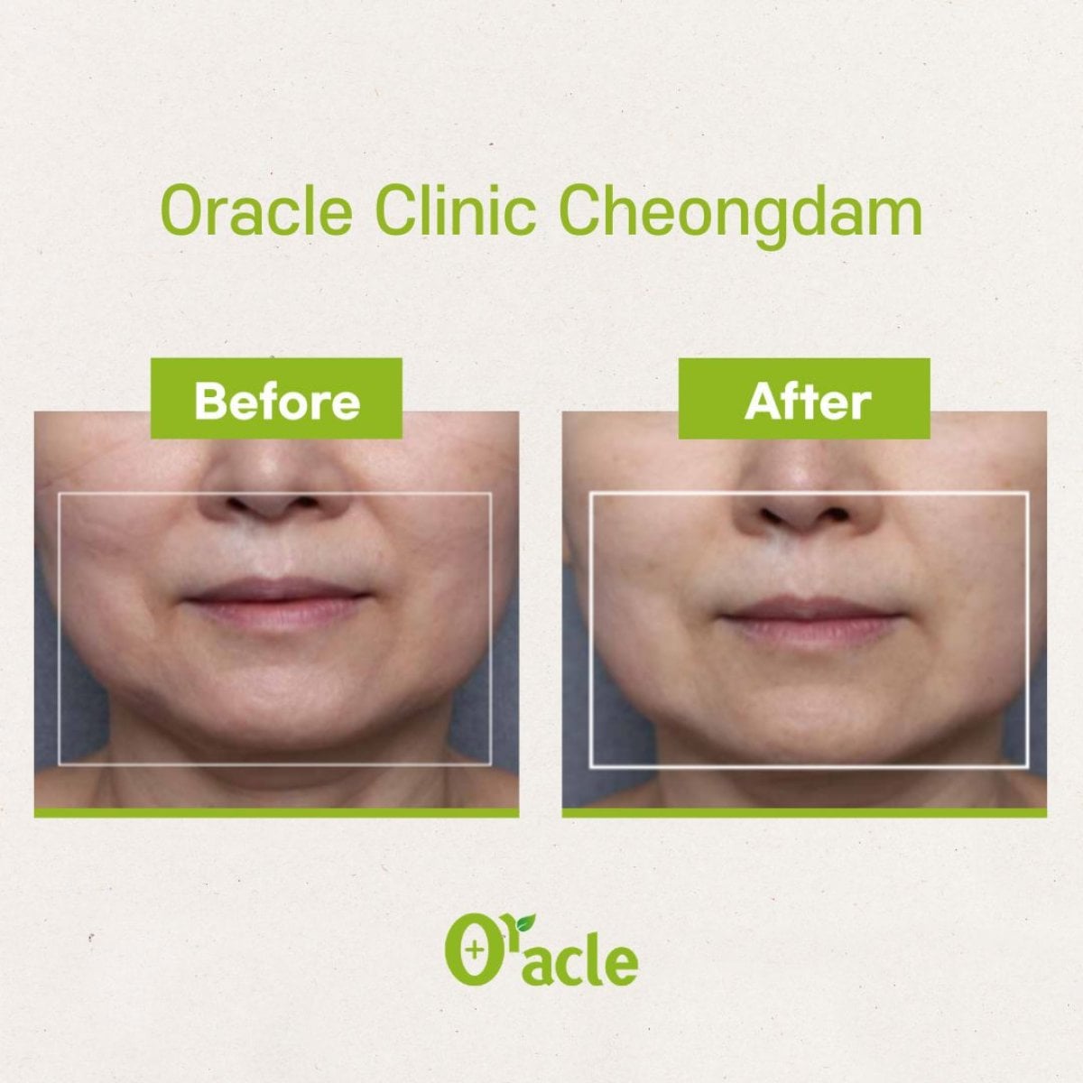 Resultados antes y después de Thermage en Oracle Clinic Cheongdam, tensado facial