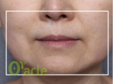 before-after photo thermage