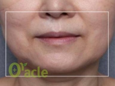before-after photo thermage