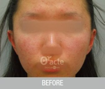 before-after photo thermage
