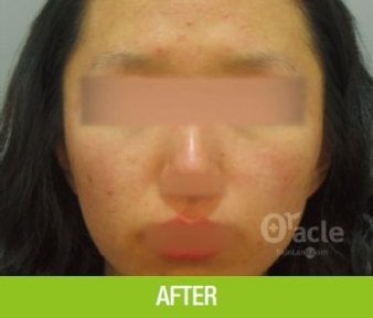 before-after photo thermage