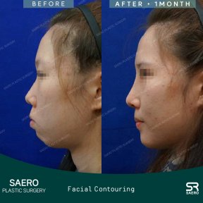 before-after photo face-contouring