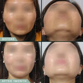 before-after photo face-contouring