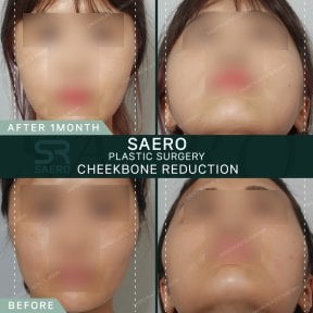 before-after photo face-contouring