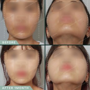 before-after photo face-contouring