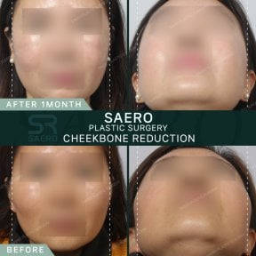 before-after photo face-contouring