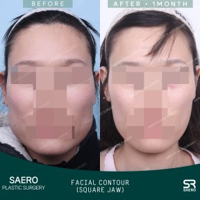before-after photo face-contouring