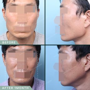 before-after photo face-contouring