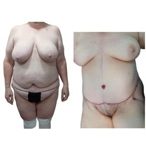 نتائج قبل وبعد عملية تجميل الأم في مستشفى دي لا فاميليا، تحسين شكل الجسم