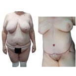 نتائج قبل وبعد عملية تجميل الأم في مستشفى دي لا فاميليا، تحسين شكل الجسم
