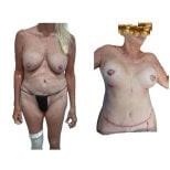 نتائج قبل وبعد عملية تجميل الأم في مستشفى دي لا فاميليا، تحسين شكل الجسم