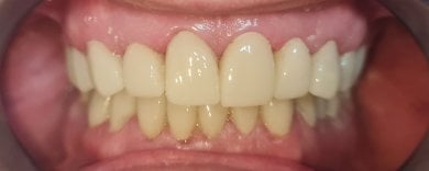 Результат установки виниров в SoftDentalCare Clinic – улучшенная улыбка и естественные зубы