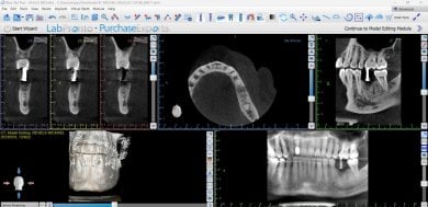 КТ для планирования дентального импланта в SoftDentalCare Clinic, структура челюсти и зубов