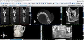 КТ для планирования дентального импланта в SoftDentalCare Clinic, структура челюсти и зубов