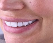 نتيجة زراعة الأسنان في Dentaland Premium Luxury Clinic & Academy – ابتسامة طبيعية