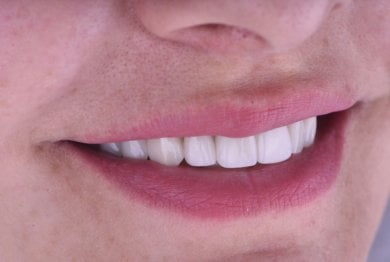 نتيجة زراعة الأسنان في Dentaland Premium Luxury Clinic & Academy – ابتسامة طبيعية