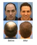 Before and after hair transplant at ID Clinic Bangkok – restored hairline and fuller scalp result