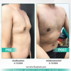 Результати до і після операції гінекомастії в Munare Clinic Chiangmai, більш плаский торс