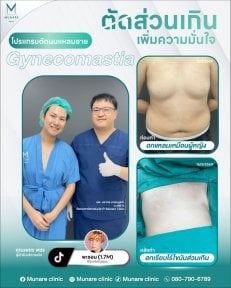 Результати до і після операції гінекомастії в Munare Clinic Chiangmai, плоскі груди