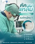 Результат операції гінекомастії в Munare Clinic Chiangmai – мінімальний шрам, швидке відновлення