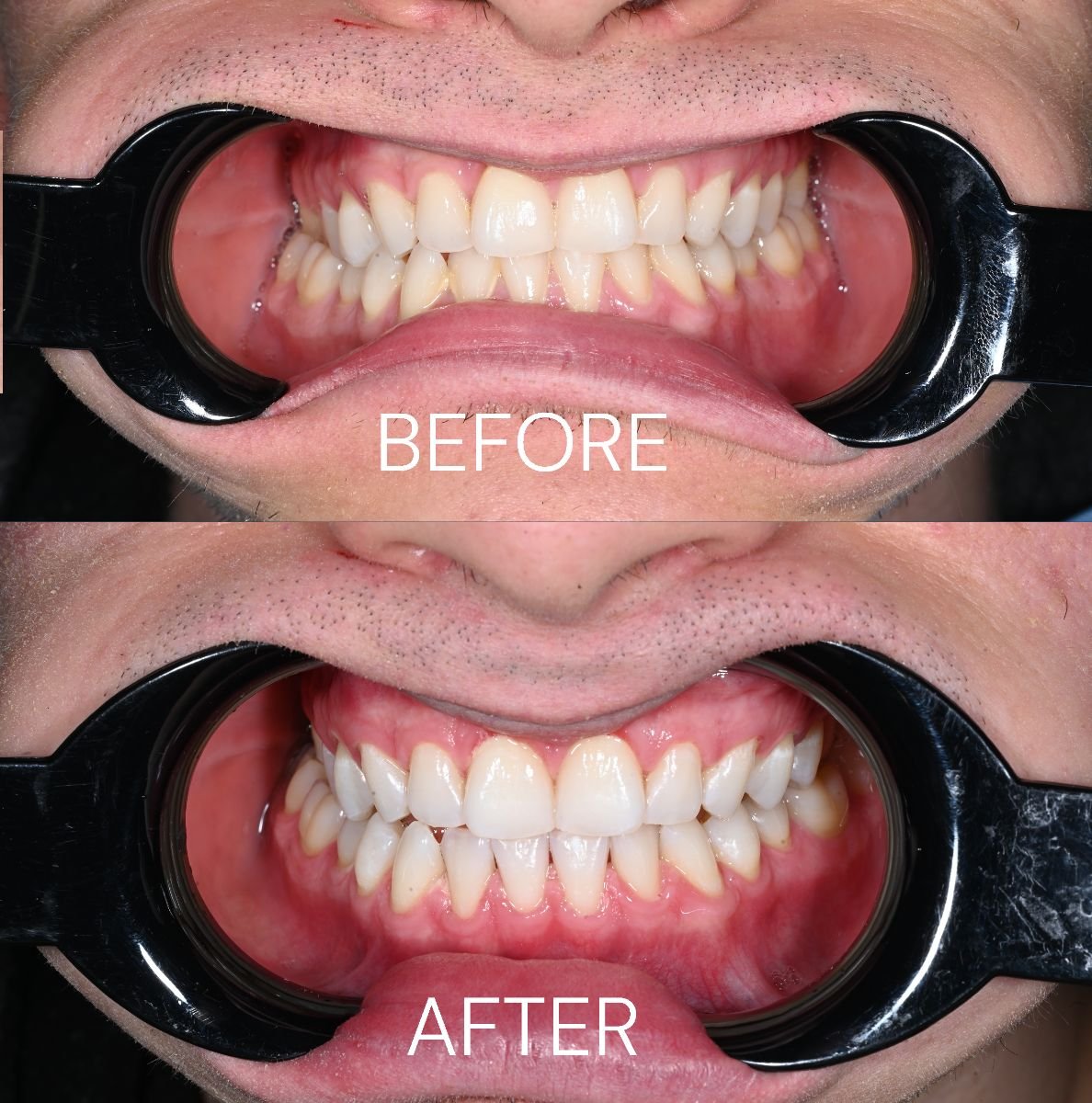 Resultados de blanqueamiento dental antes y después en Unident Clinic: sonrisa más brillante