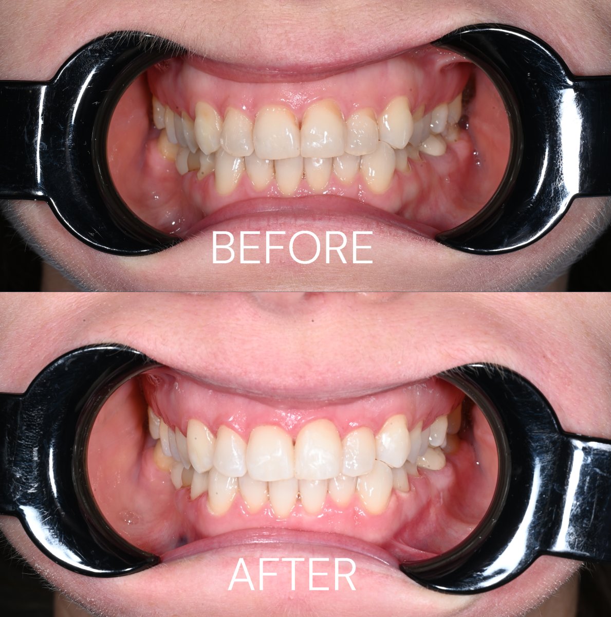 Resultados de blanqueamiento dental láser antes y después en Unident Clinic – sonrisa brillante