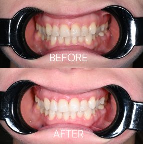 Resultados de blanqueamiento dental láser antes y después en Unident Clinic – sonrisa brillante