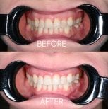 Resultados de blanqueamiento dental láser antes y después en Unident Clinic – sonrisa brillante
