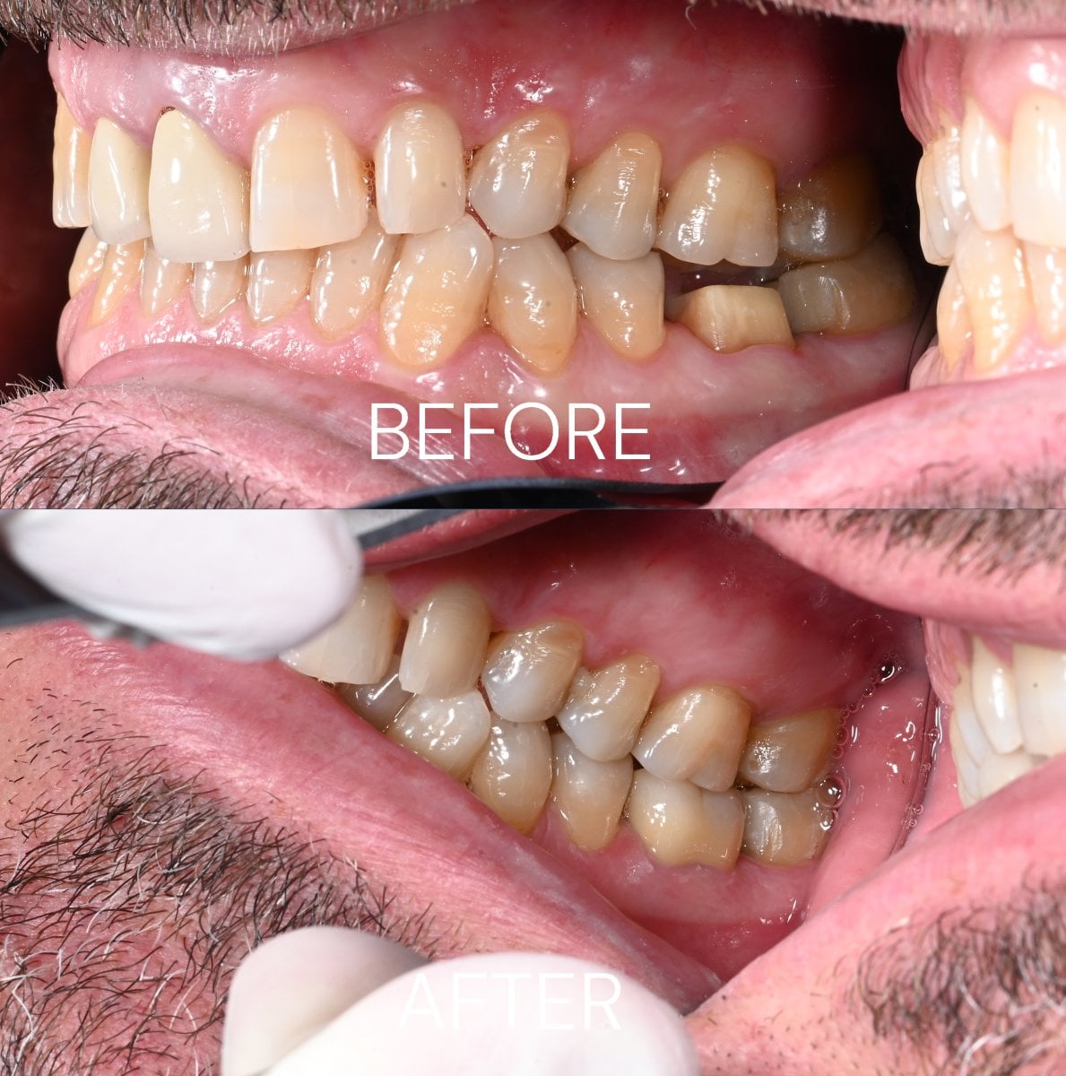 Antes y después de coronas de zirconia en Unident Clinic – mejora estética de la sonrisa