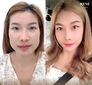 Before and after Botox injections at René Clinic – smoother, lifted facial contour result