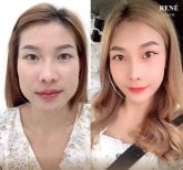 Before and after Botox injections at René Clinic – smoother, lifted facial contour result