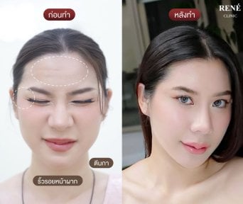 Resultados antes y después de botox en René Clinic, frente lisa y piel rejuvenecida
