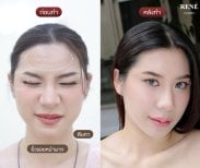 Resultados antes y después de botox en René Clinic, frente lisa y piel rejuvenecida