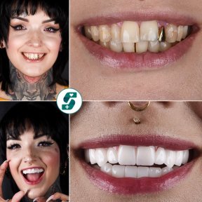 Résultats avant et après Hollywood Smile chez Soraca Med – facettes pour sourire éclatant
