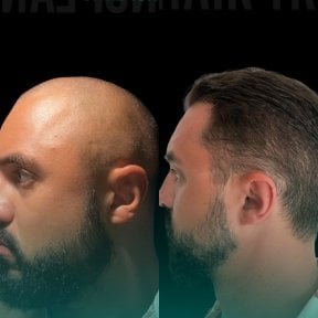 Результати пересадки волосся до і після в Soraca Med – відновлена лінія волосся у чоловіка