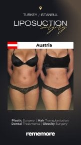 before-after photo j-plasma-renuvion