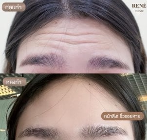 Reducción de arrugas en la frente antes y después de botox en René Clinic, piel lisa