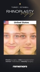 before-after photo rhinoplasty-nose-job