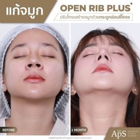 نتيجة عملية تجميل الأنف في DGB Clinic بتقنية Open Rib Plus قبل وبعد شهر