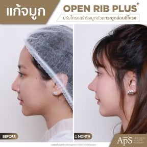 Before and after rhinoplasty result at DGB Clinic, nose reshaping with open rib technique