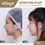 Before and after rhinoplasty result at DGB Clinic, nose reshaping with open rib technique