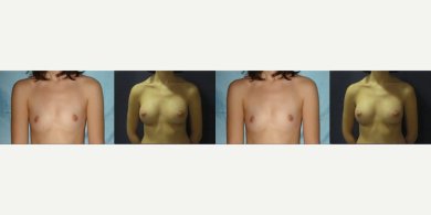before-after photo reconstructive-breast-surgery