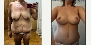 before-after photo reconstructive-breast-surgery