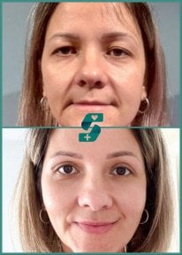 before-after photo upper-and-lower-eyelid-surgery