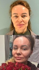 before-after photo upper-and-lower-eyelid-surgery