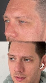 before-after photo upper-and-lower-eyelid-surgery