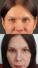 before-after photo upper-and-lower-eyelid-surgery