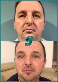 before-after photo upper-and-lower-eyelid-surgery