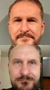 before-after photo upper-and-lower-eyelid-surgery